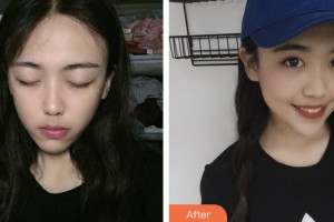 齊齊哈爾千百度整形美容醫(yī)院姜欣整形價(jià)格表附眼部綜合案例展示