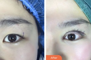 齊齊哈爾愛(ài)爾眼科醫(yī)院張焱整形價(jià)格表附眼部綜合案例展示