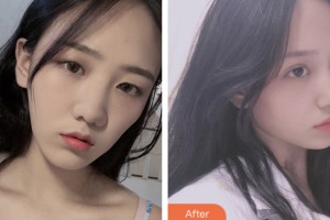 齊齊哈爾千百度整形美容醫(yī)院李鳳浩整形價(jià)格表附切開(kāi)雙眼皮案例展示