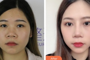 齊齊哈爾千百度整形美容醫(yī)院蔡里整形價(jià)格表附切開(kāi)雙眼皮案例展示