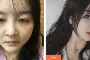 鹽城艾美莉整形美容醫(yī)院武崇高整形價(jià)格表附切開雙眼皮案例展示