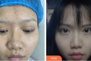 鹽城艾美莉整形美容醫(yī)院鄭基鎬整形價(jià)格表附眼部修復(fù)案例展示