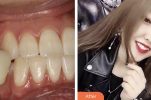 鹽城東方婦產(chǎn)醫(yī)院整形美容中心成潔整形價(jià)格表附冷光美白案例展示