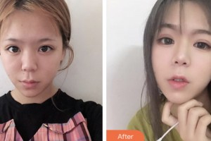 鹽城美得麗德整形美容門診部鄭在旭整形價(jià)格表附熱拉提案例展示