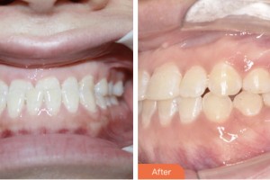 鹽城倍美永康口腔門診部張蓉整形價(jià)格表附金屬托槽矯正案例展示