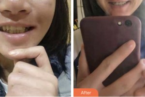 鹽城倍美永康口腔門診部李晶整形價(jià)格表附金屬托槽矯正案例展示