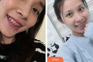 鹽城倍美永康口腔門診部陸鋒整形價(jià)格表附自鎖托槽矯正案例展示