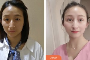 鹽城朝聚眼科醫(yī)院胡恩海整形價(jià)格表附切開(kāi)雙眼皮案例展示