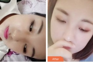 鹽城朝聚眼科醫(yī)院盧新華整形價(jià)格表附埋線雙眼皮案例展示