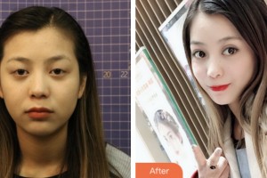 鹽城朝聚眼科醫(yī)院鄭晨超整形價(jià)格表附切開(kāi)雙眼皮案例展示