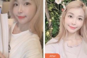 鹽城朝聚眼科醫(yī)院和大力整形價(jià)格表附切開(kāi)雙眼皮案例展示