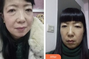 淮安第一人民醫(yī)院整形美容外科彭加禮整形價格表附眼部綜合案例展示