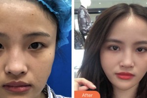 淮安漣水縣人民醫(yī)院燒傷整形科王永超整形價格表附雙眼皮案例展示