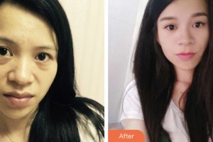 淮安市婦幼保健院醫(yī)療美容科許敏整形價格表附激光去眼袋案例展示