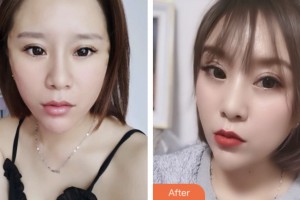 淮安市中醫(yī)院醫(yī)學(xué)美容科仲祥西整形價格表附埋線提升案例展示