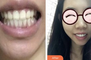 淮安城際口腔醫(yī)院高士國整形價格表附美白貼片案例展示