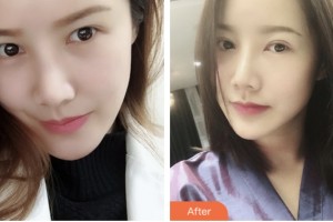 淮安愛爾眼科醫(yī)院肖耀廷整形價格表附切開雙眼皮案例展示