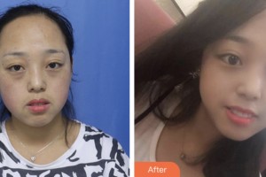 淮安愛爾眼科醫(yī)院張偉整形價格表附激光去眼袋案例展示