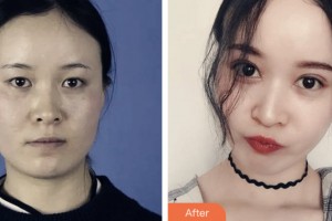 淮安愛爾眼科醫(yī)院李文化整形價格表附切開雙眼皮案例展示