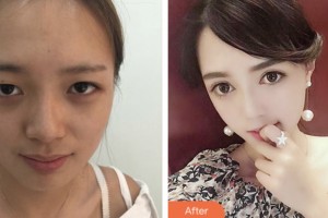 淮安光明眼科醫(yī)院劉慶準整形價格表附切開雙眼皮案例展示