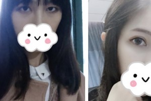 淮安光明眼科醫(yī)院趙少貞整形價格表附眼部綜合案例展示