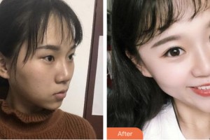 淮安光明眼科醫(yī)院劉鳳整形價格表附切開雙眼皮案例展示