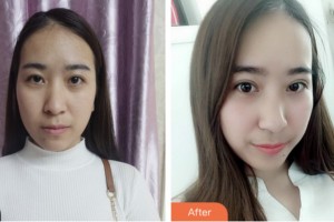 淮安光明眼科醫(yī)院劉巨平整形價格表附切開雙眼皮案例展示