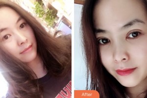 淮安光明眼科醫(yī)院姜蘇整形價格表附切開雙眼皮案例展示