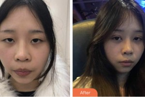 淮安光明眼科醫(yī)院宋建軍整形價格表附切開雙眼皮案例展示