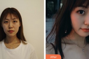 淮安光明眼科醫(yī)院張勝玉整形價格表附埋線雙眼皮案例展示