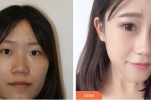 婁底德美醫(yī)療整形美容診所曾良生整形價格表附埋線雙眼皮案例展示