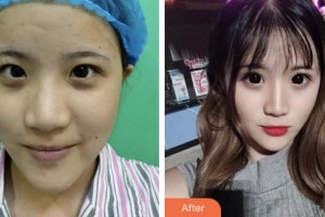 婁底美科醫(yī)療美容門診部（原婁底華美整形美容醫(yī)院）姜昌君整形價格表附切開雙眼皮案例展示