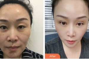 婁底美科醫(yī)療美容門診部（原婁底華美整形美容醫(yī)院）俞勝英 整形價格表附眼部綜合案例展示