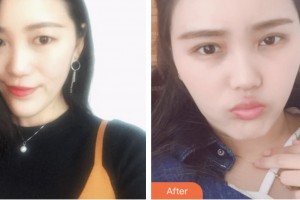 婁底市中醫(yī)院燒傷整形科彭細(xì)峰 整形價格表附眼部綜合案例展示