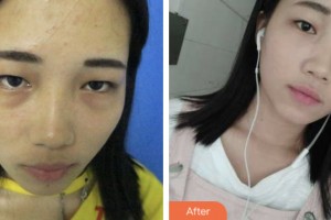 婁底市中醫(yī)院燒傷整形科賀建雄整形價格表附激光去眼袋案例展示