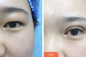 婁底市第一人民醫(yī)院燒傷整形外科牛方明整形價格表附眼部綜合案例展示