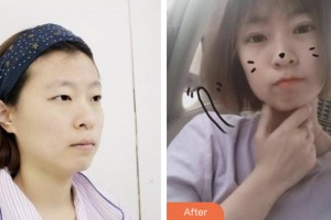 婁底市中醫(yī)院燒傷整形科鄧建光整形價格表附切開雙眼皮案例展示