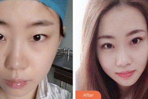 婁底德美醫(yī)療整形美容診所譚敏整形價格表附眼部綜合案例展示