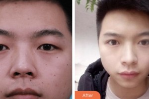 婁底市中心醫(yī)院整形美容科劉自飛整形價格表附切開雙眼皮案例展示