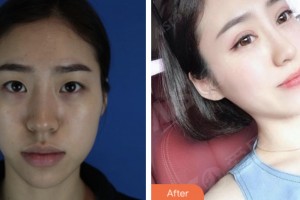 婁底市中心醫(yī)院整形美容科潘葵整形價格表附眼部綜合案例展示