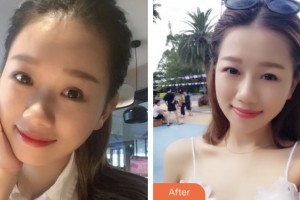 婁底希美醫(yī)療美容門診部騰召勇整形價格表附隆鼻案例展示