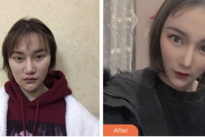 婁底愛思特醫(yī)療美容醫(yī)院謝勁松整形價格表附肋軟骨隆鼻案例展示