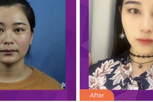 婁底希美醫(yī)療美容門診部汪多整形價格表附假體隆鼻案例展示