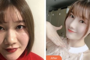 婁底愛思特醫(yī)療美容醫(yī)院劉珊珊整形價格表附耳軟骨復(fù)合隆鼻案例展示