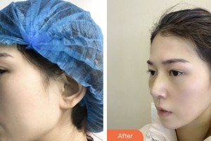 婁底市第一人民醫(yī)院燒傷整形外科邱建才整形價格表附鼻部綜合案例展示