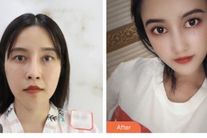 婁底市第一人民醫(yī)院燒傷整形外科周勇整形價格表附鼻修復(fù)案例展示