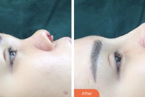 婁底市第一人民醫(yī)院燒傷整形外科曹毅整形價格表附鼻部綜合案例展示