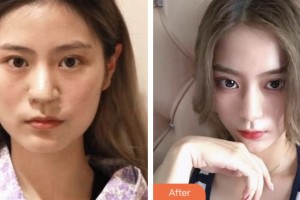 湘潭華雅整形美容醫(yī)院馮潤川整形價格表附鼻部綜合案例展示