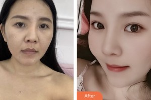 拉薩維多利亞整形美容醫(yī)院徐杰明整形價(jià)格表附牙齒隱形矯正案例展示