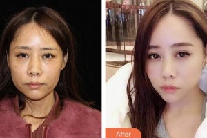 荊門中翰整形美容醫(yī)院溫成平整形價(jià)格表附埋線提升案例展示